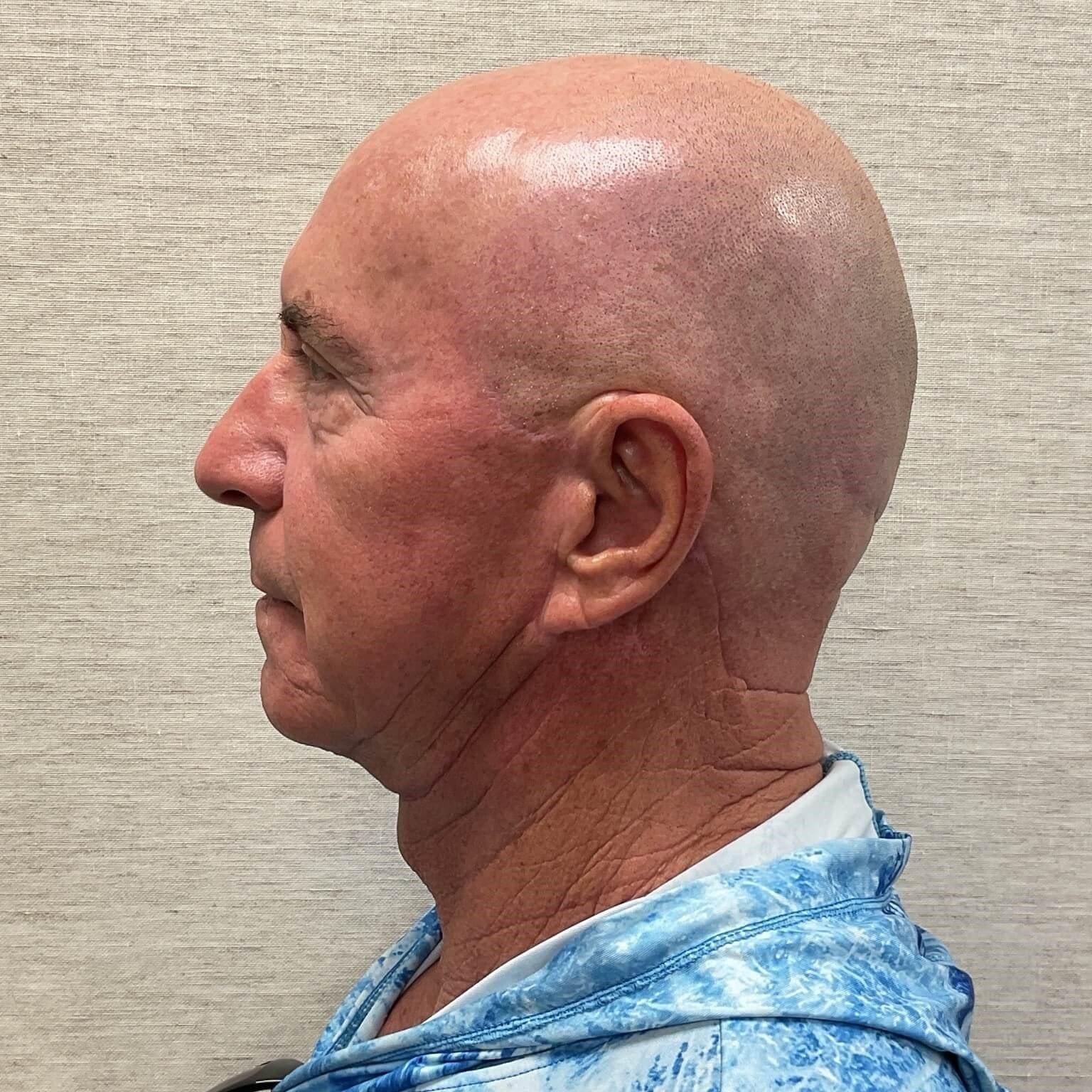 Watt Plastic Surgery facelift after — Tampa, FL