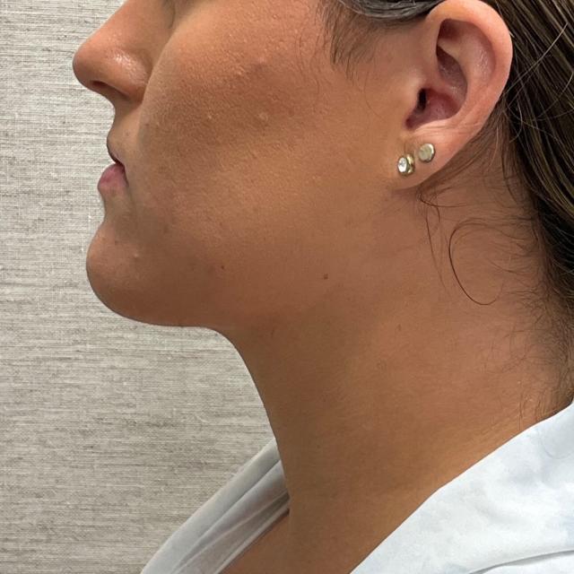 Neck Liposuction after at Watt Plastic Surgery in Tampa, FL