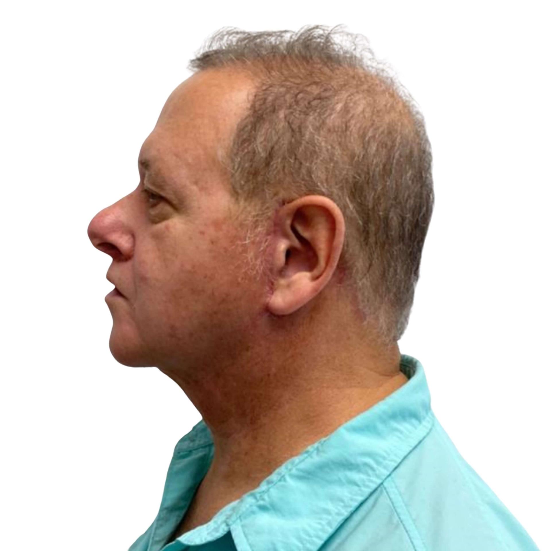 Watt Plastic Surgery neck lift after — Tampa, FL