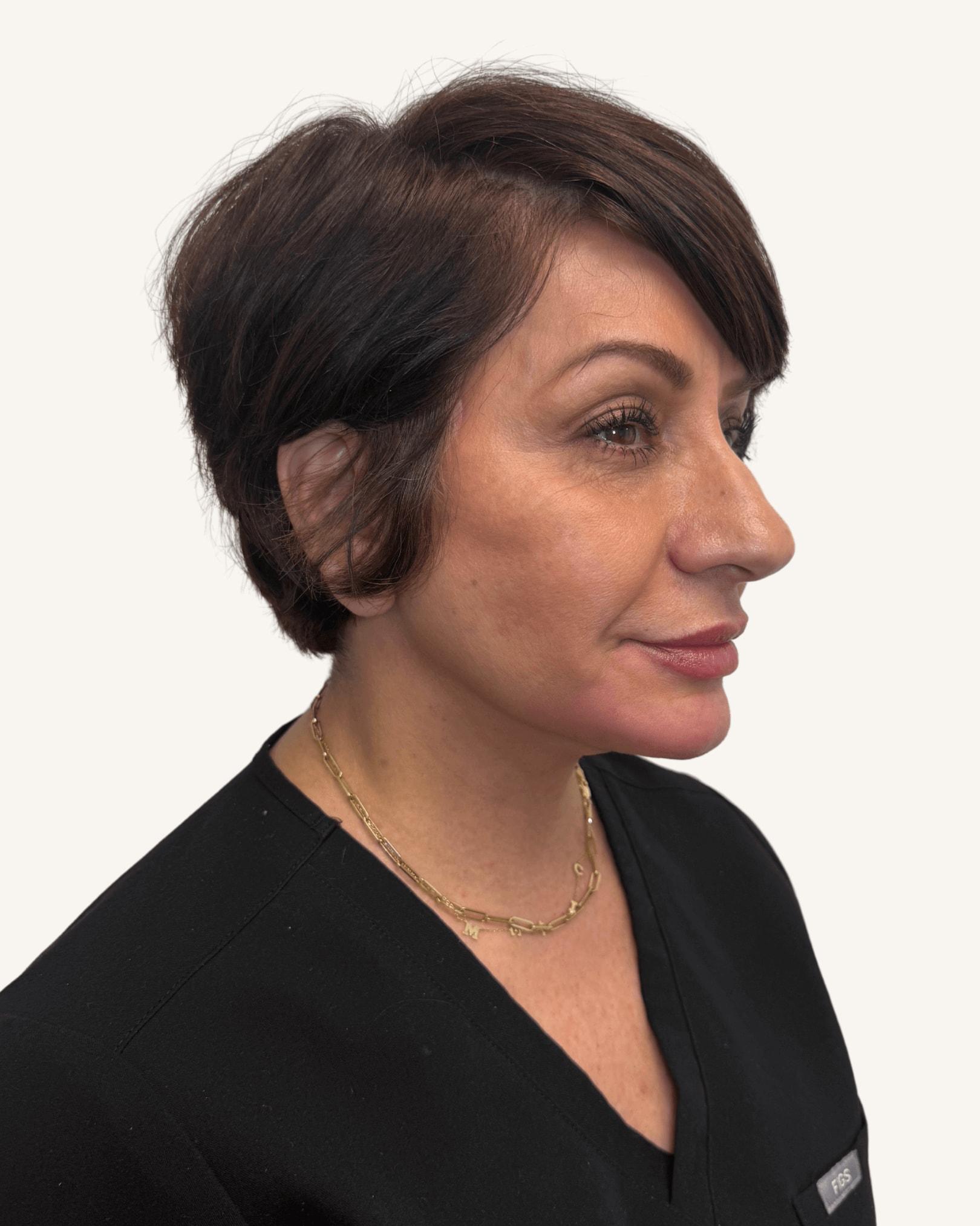 Watt Plastic Surgery facelift after — Tampa, FL