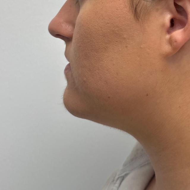 Neck Liposuction before at Watt Plastic Surgery in Tampa, FL
