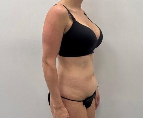 Mini Tummy Tuck before at Watt Plastic Surgery in Tampa, FL