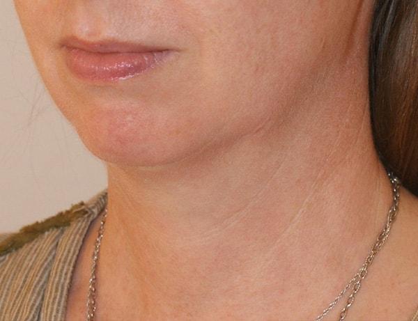 Neck Lift before at Dino Elyassnia, MD in San Francisco, CA