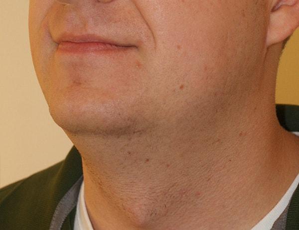 Neck Lift before at Dino Elyassnia, MD in San Francisco, CA