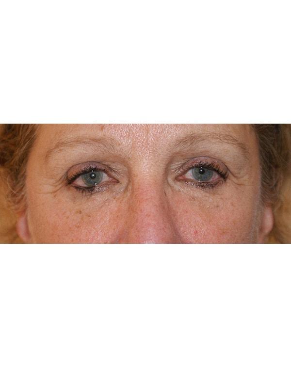 Dino Elyassnia, MD fat transfer after — San Francisco, CA