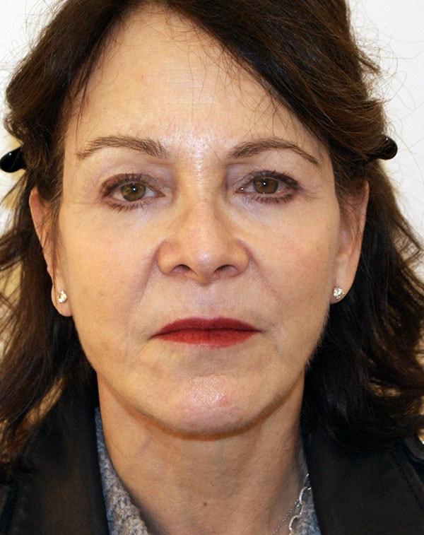 Dino Elyassnia, MD facelift after — San Francisco, CA
