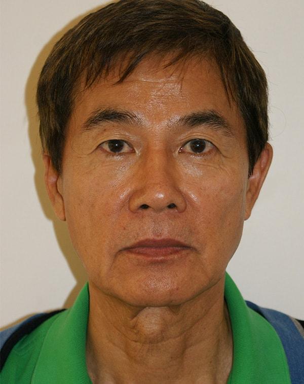 Neck Lift before at Dino Elyassnia, MD in San Francisco, CA