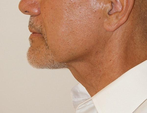Dino Elyassnia, MD neck lift after — San Francisco, CA