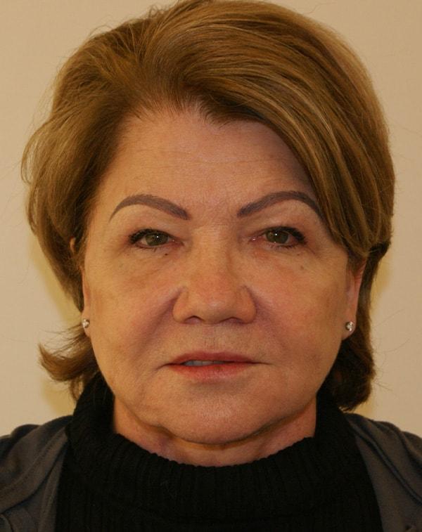 Dino Elyassnia, MD facelift after — San Francisco, CA