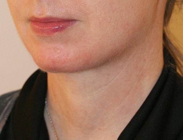 Dino Elyassnia, MD neck lift after — San Francisco, CA