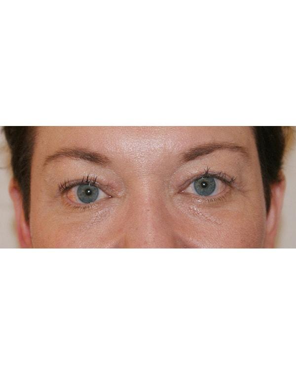 Dino Elyassnia, MD fat transfer after — San Francisco, CA