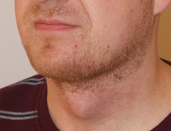 Dino Elyassnia, MD neck lift after — San Francisco, CA
