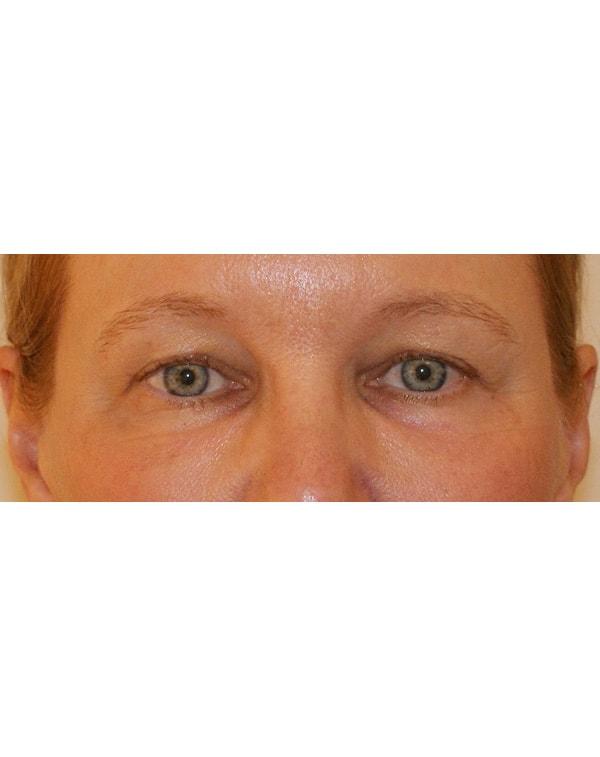Dino Elyassnia, MD fat transfer after — San Francisco, CA