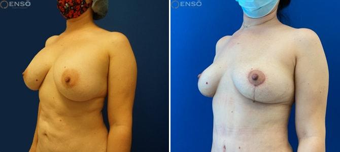 Dr. Paul Durand, MD breast implant removal result — Miami, FL