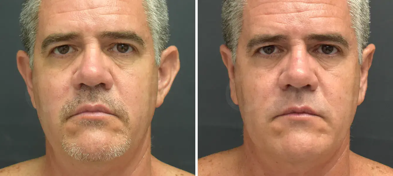 Dr. Paul Durand, MD otoplasty result — Miami, FL