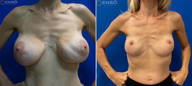 Dr. Paul Durand, MD breast implant removal result — Miami, FL