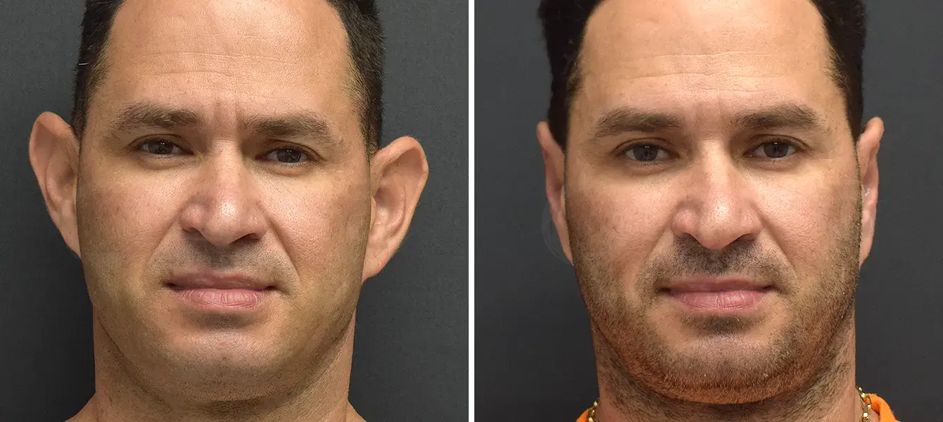 Dr. Paul Durand, MD otoplasty result — Miami, FL