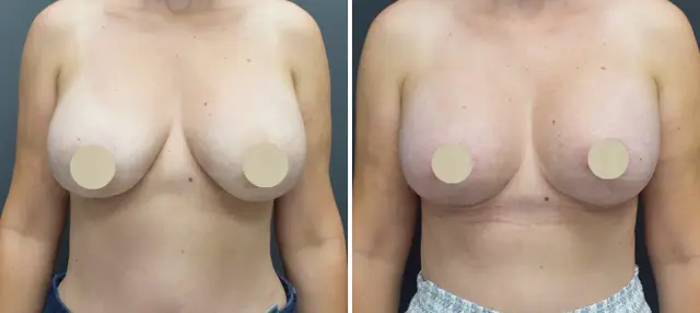 Breast Lift result at Dr. Paul Durand, MD in Miami, FL