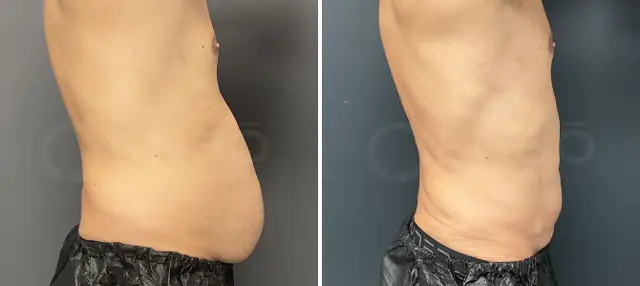 Liposuction result at Dr. Paul Durand, MD in Miami, FL
