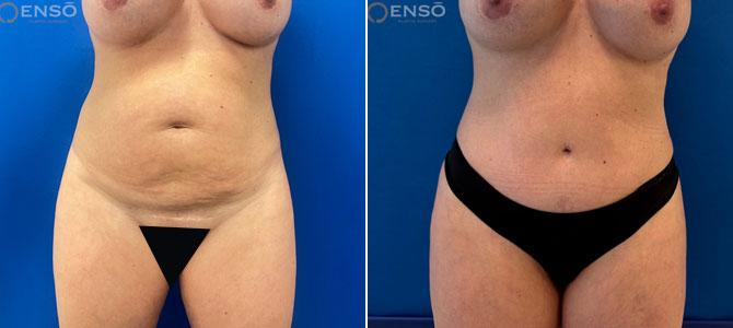 Dr. Paul Durand, MD tummy tuck result — Miami, FL