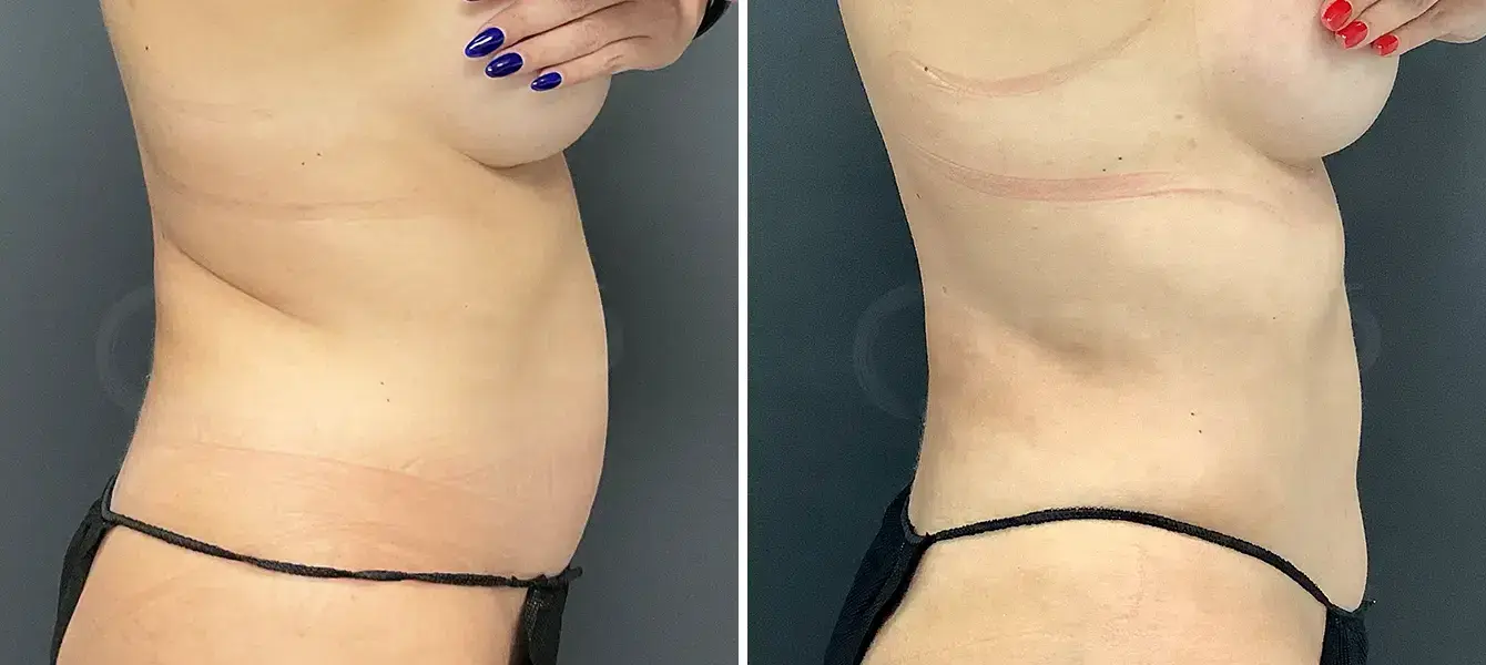 Dr. Paul Durand, MD liposuction result — Miami, FL