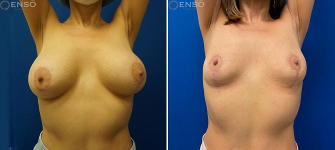 Dr. Paul Durand, MD breast implant removal result — Miami, FL