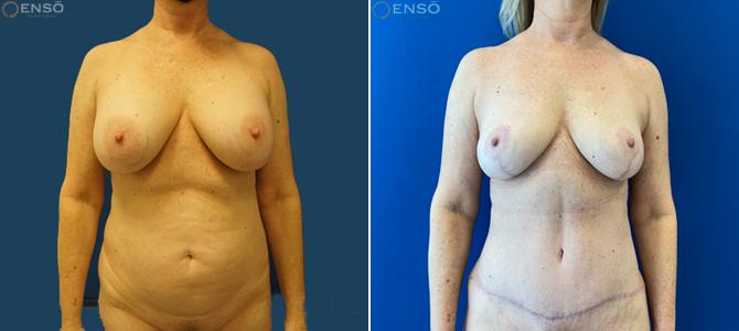 Dr. Paul Durand, MD tummy tuck result — Miami, FL