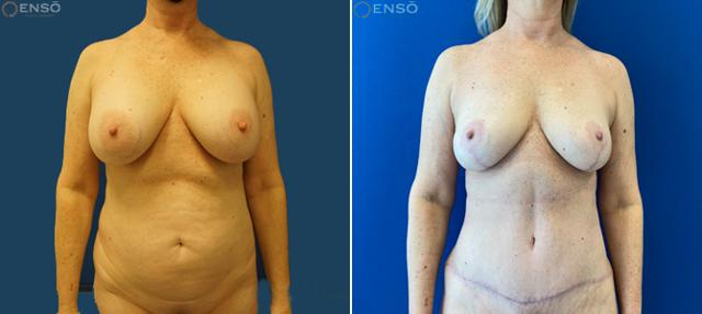 Tummy Tuck result at Dr. Paul Durand, MD in Miami, FL
