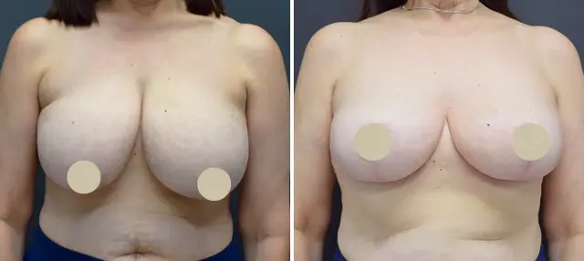 Breast Reduction result at Dr. Paul Durand, MD in Miami, FL