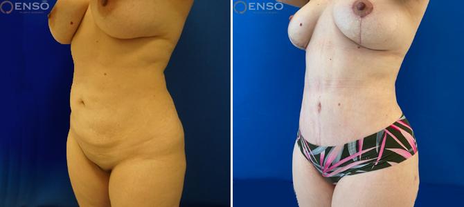 Dr. Paul Durand, MD tummy tuck result — Miami, FL