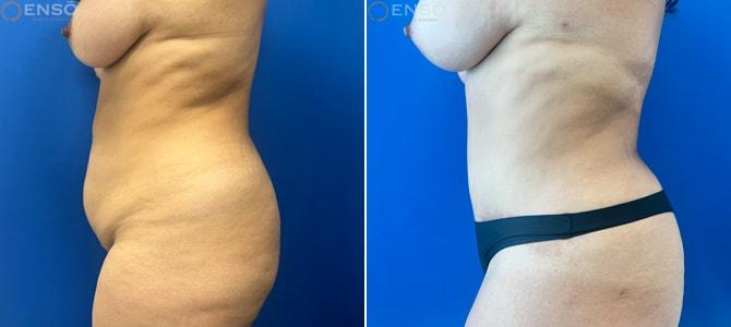 Dr. Paul Durand, MD tummy tuck result — Miami, FL