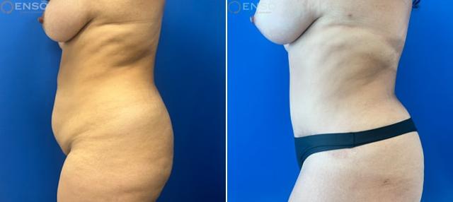 Mini Tummy Tuck result at Dr. Paul Durand, MD in Miami, FL