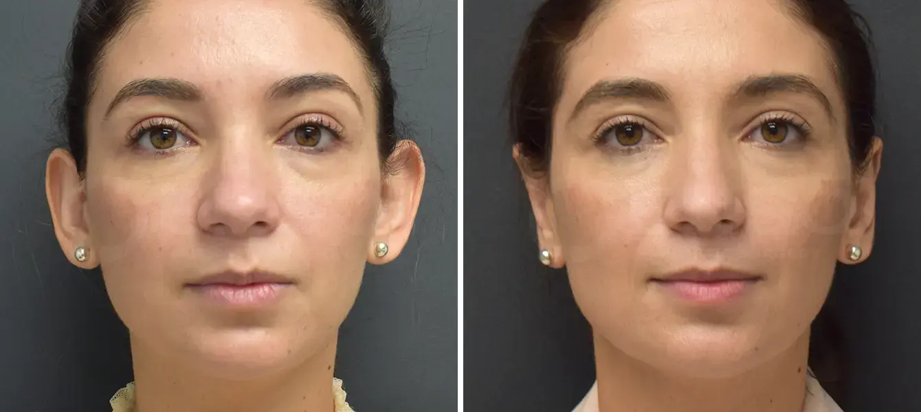 Dr. Paul Durand, MD otoplasty result — Miami, FL