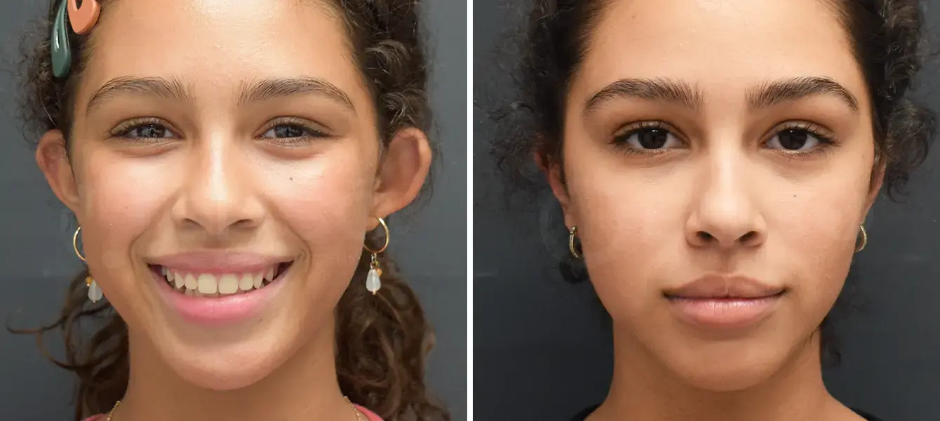 Dr. Paul Durand, MD otoplasty result — Miami, FL