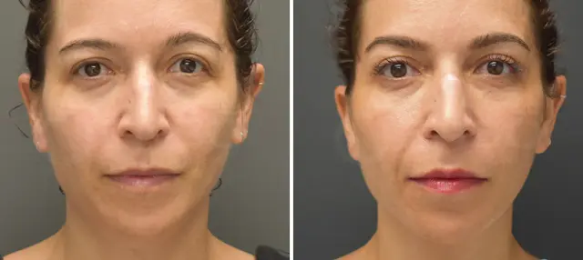 Blepharoplasty result at Dr. Paul Durand, MD in Miami, FL