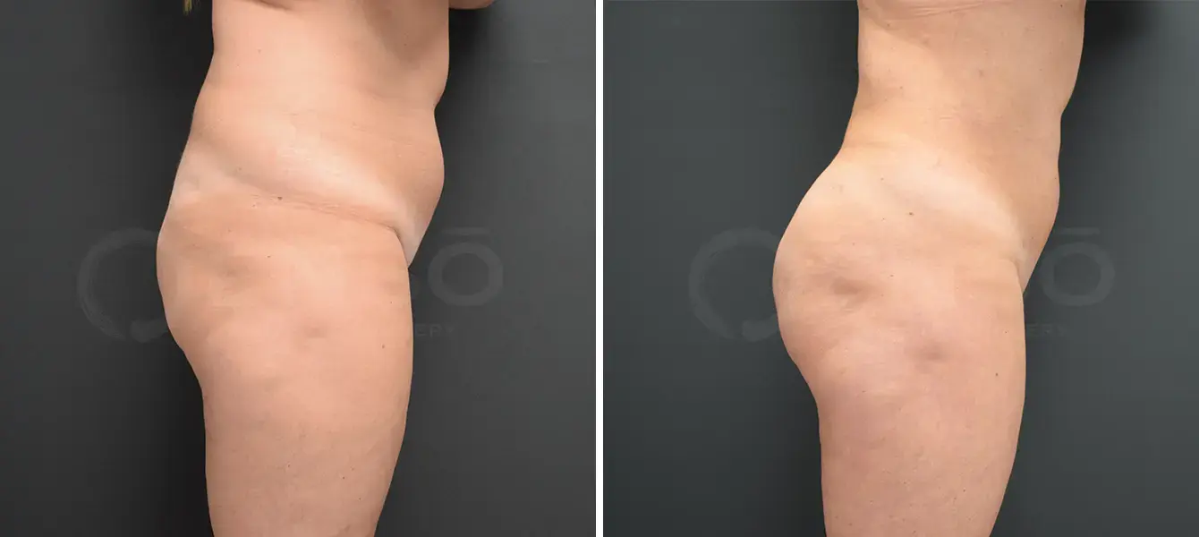 Dr. Paul Durand, MD liposuction result — Miami, FL
