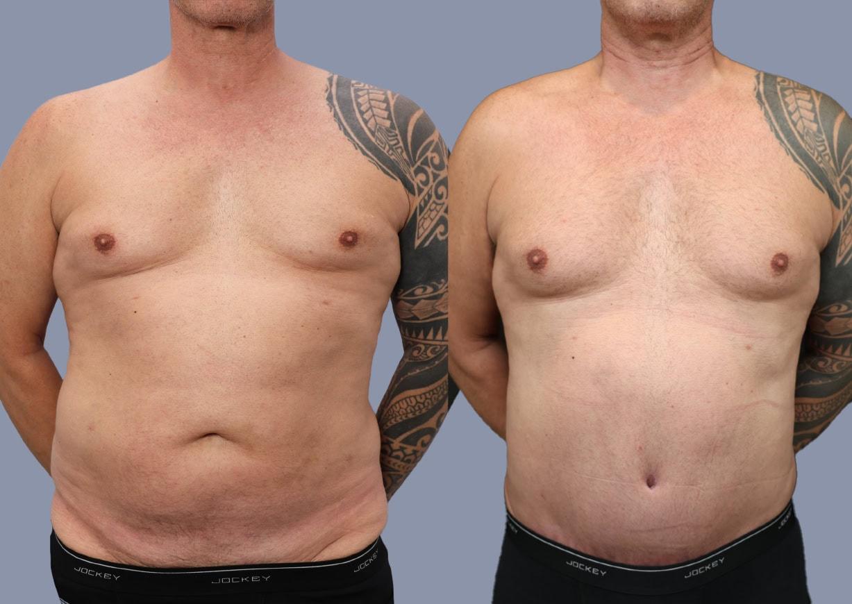 Michael J. Stein, MD tummy tuck result — New York, NY
