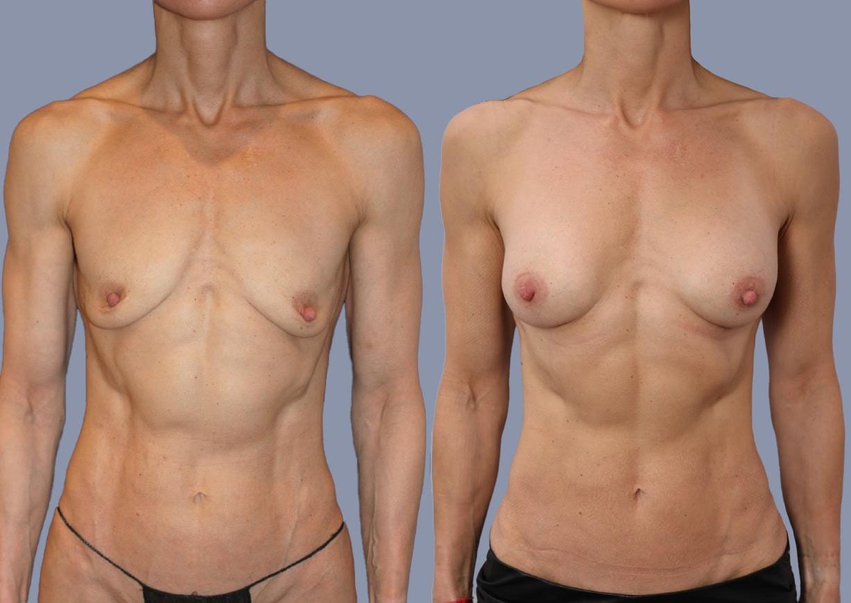 Michael J. Stein, MD breast augmentation result — New York, NY