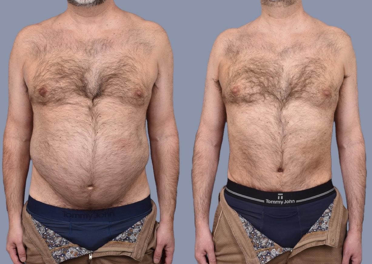 Michael J. Stein, MD tummy tuck result — New York, NY