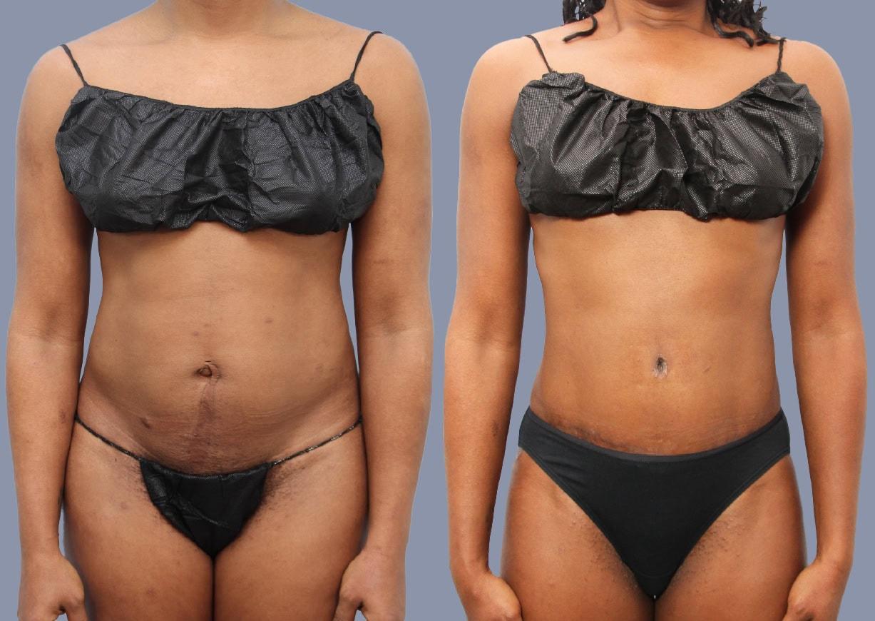Michael J. Stein, MD tummy tuck result — New York, NY