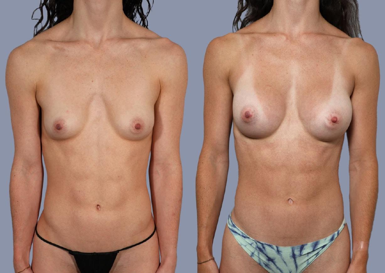 Michael J. Stein, MD breast augmentation result — New York, NY