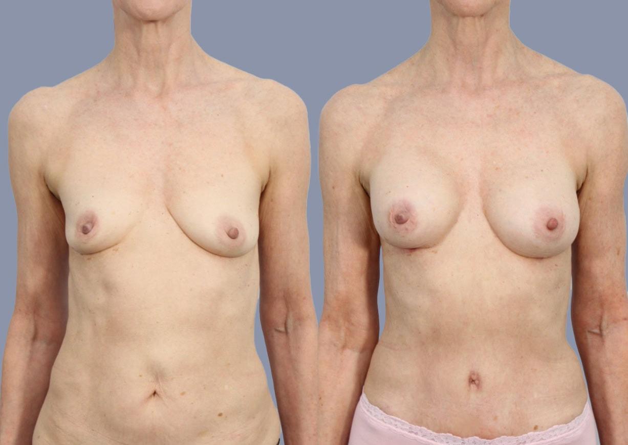 Michael J. Stein, MD breast augmentation result — New York, NY