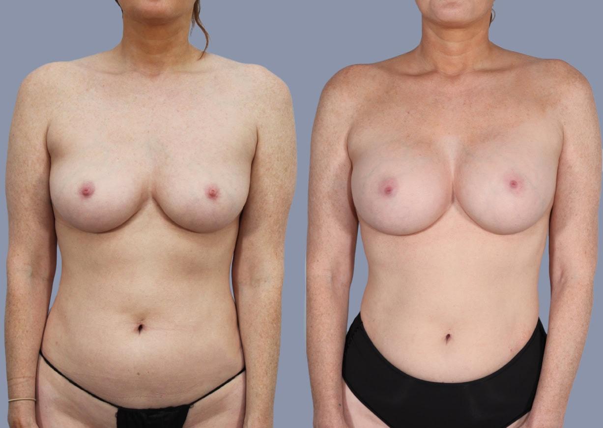 Michael J. Stein, MD breast augmentation result — New York, NY