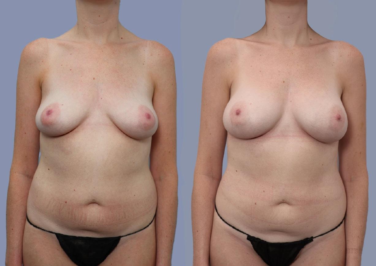 Michael J. Stein, MD breast augmentation result — New York, NY
