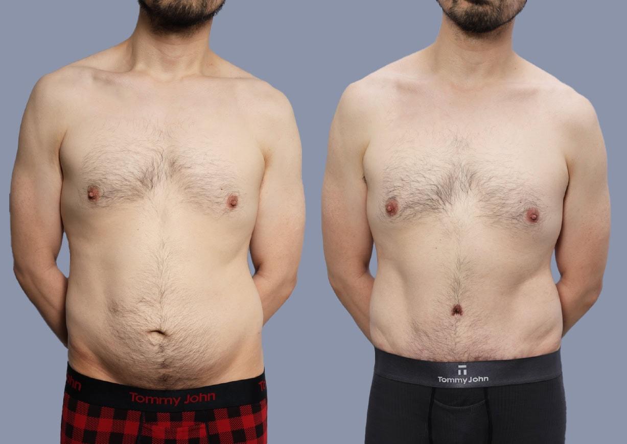 Michael J. Stein, MD tummy tuck result — New York, NY