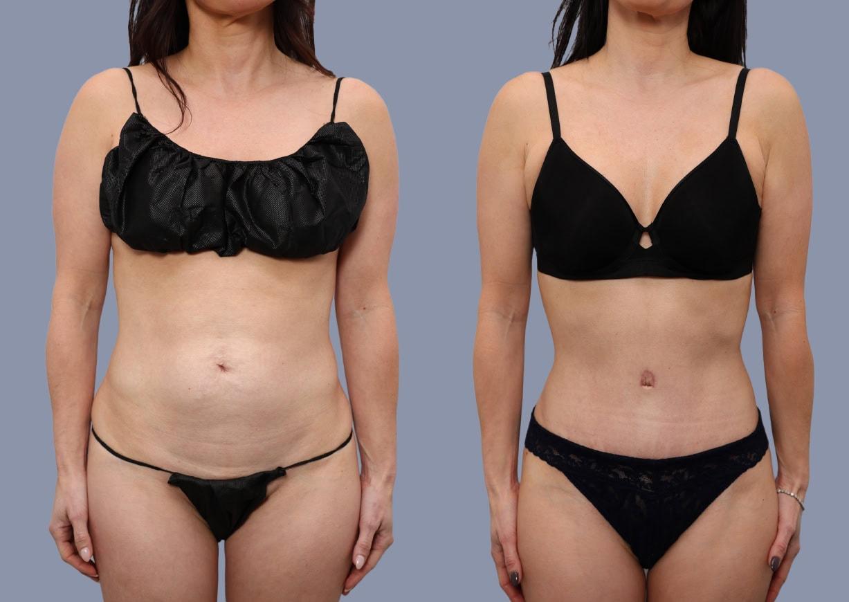 Michael J. Stein, MD tummy tuck result — New York, NY