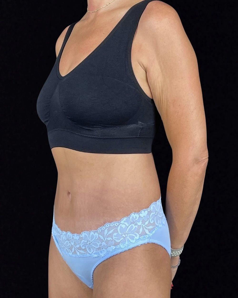 NOVA Plastic Surgery tummy tuck after — McLean, VA
