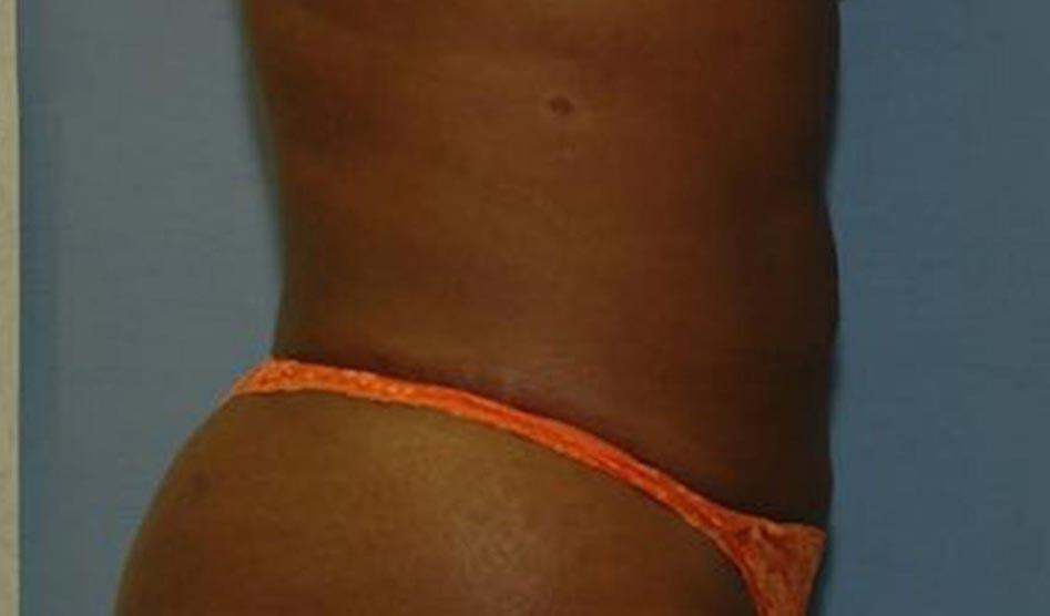 The South Shore Cosmetic Surgeons liposuction after — Rockville Centre, NY