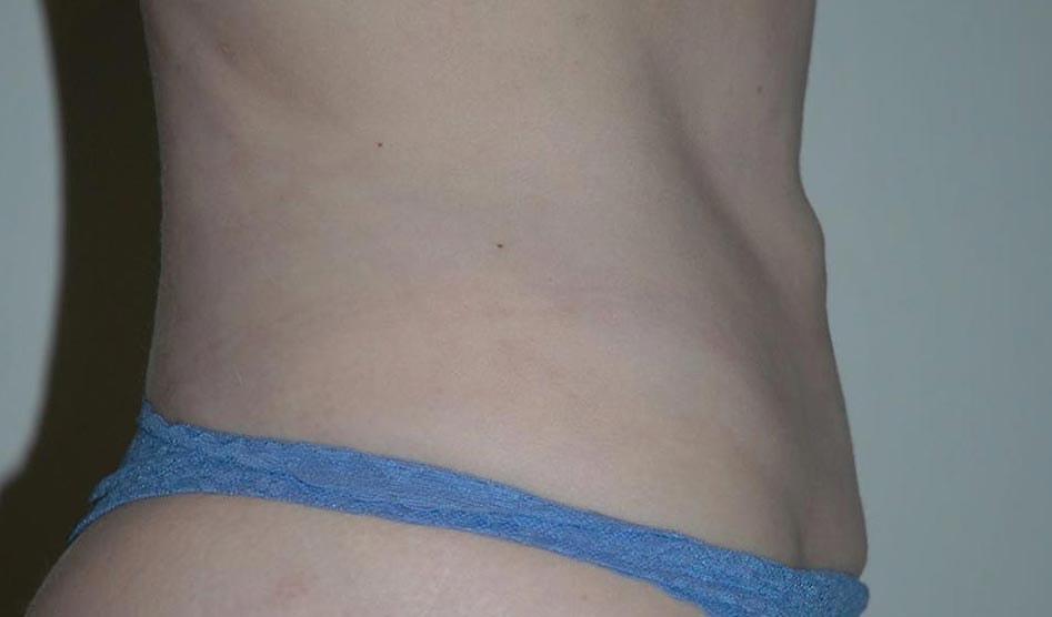 The South Shore Cosmetic Surgeons liposuction after — Rockville Centre, NY
