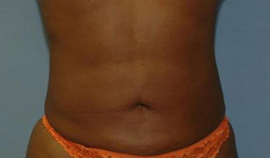 The South Shore Cosmetic Surgeons liposuction after — Rockville Centre, NY